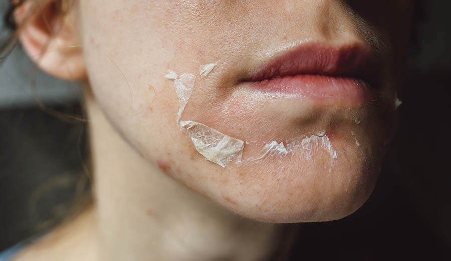 Chemical Peeling