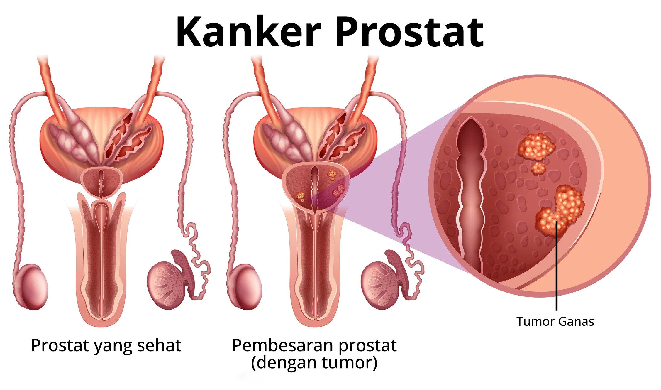 Kanker Prostat
